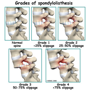 lumbar_spondylolisthesis_grades