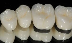 Безметалловая керамика в стоматологии. Преимущества и недостатки