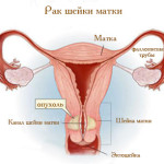 Рак шейки матки: стадии, особенности лечения в Израиле и прогнозы выживаемости