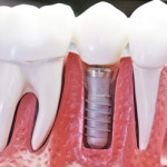 Имплантация в стоматологичеcкой клинике – это не только красивая улыбка!